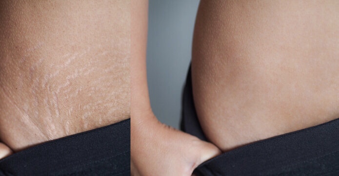 Stretch Mark Technique at ALOS STUDIO in BORING, OR