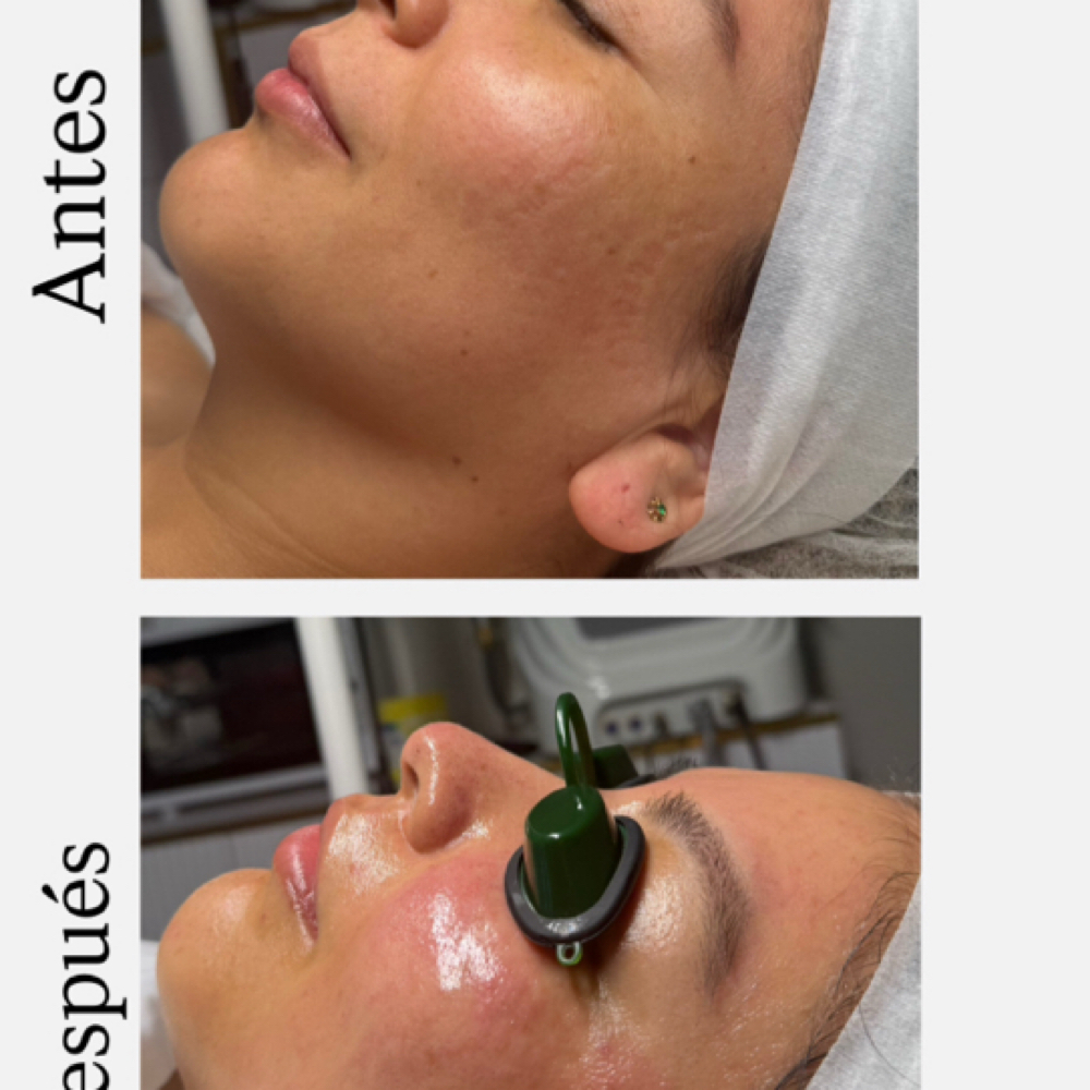 Plasma Rico En Plaquetas at Any Beauty Aesthetics Care in New York, NY