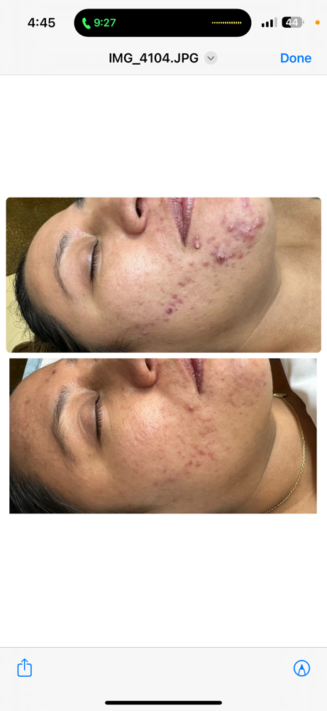 Acne Facial