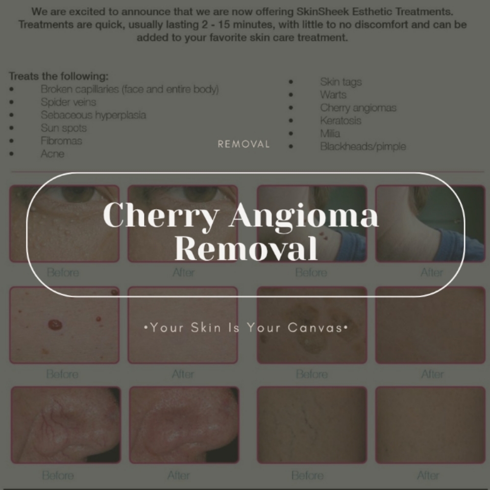 Cherry Angioma Removal at Face Palette Aesthetics in Franklin, WI
