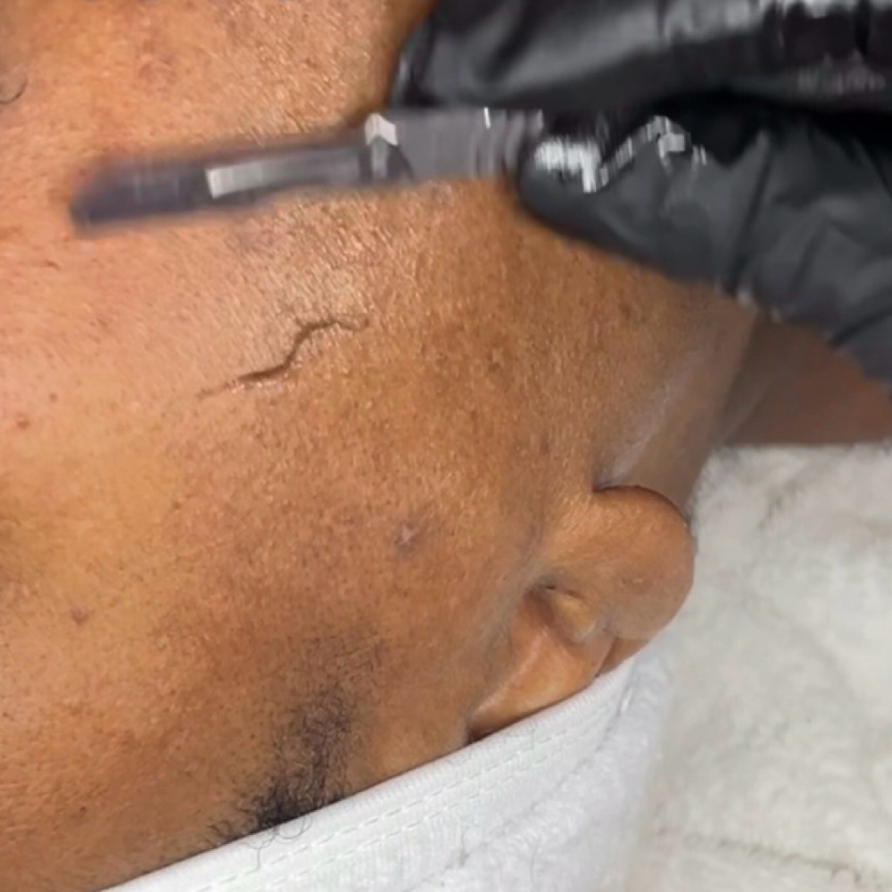 Dermaplaning Facial at Prime Skin  Esthetics in Belleville, NJ