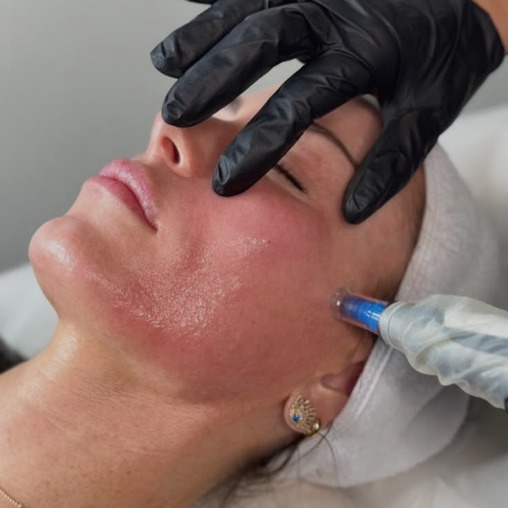 SkinPen® Add-Ons at Everlasting Aesthetics LLC in Surprise, AZ
