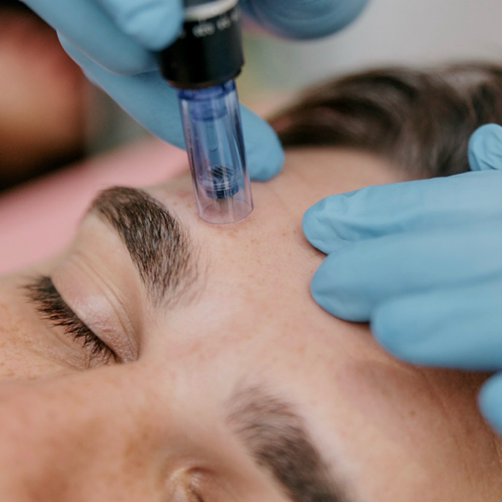 Microneedling at Aesthetics by Alli in Eagle, ID
