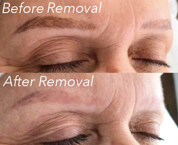 Brow Removal