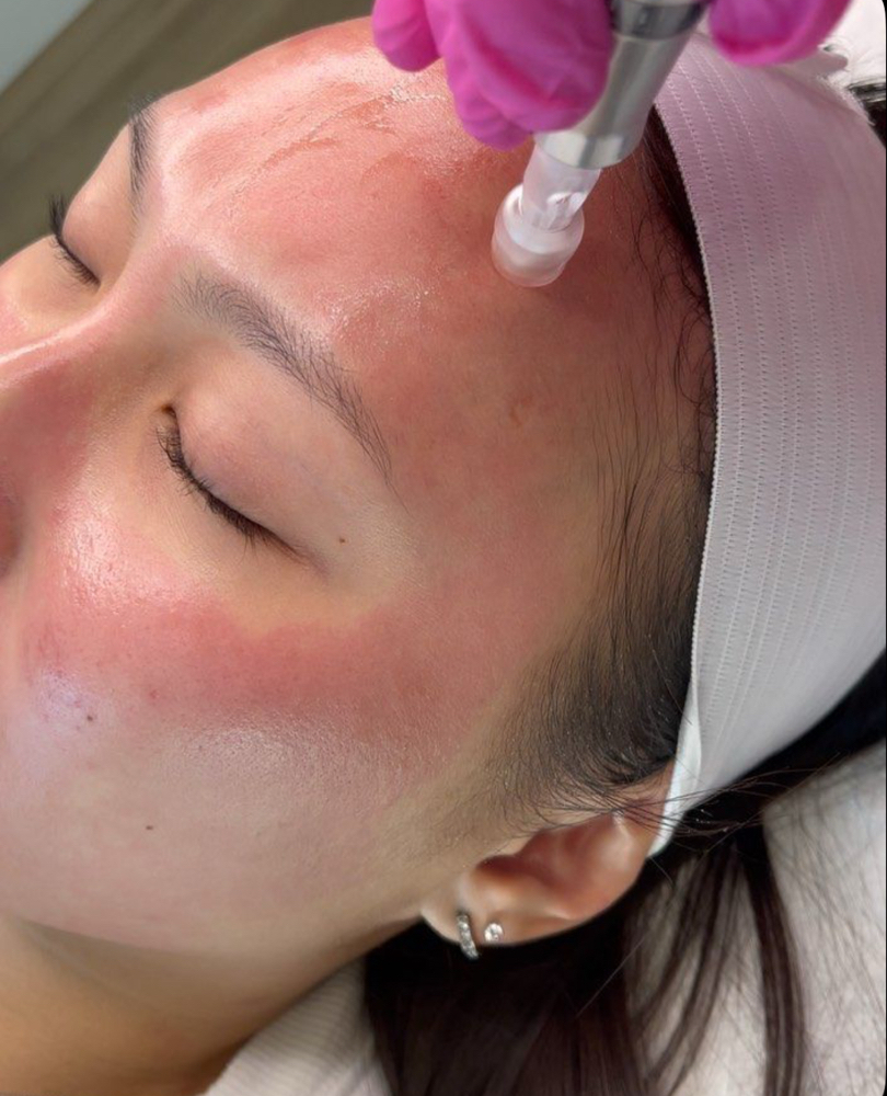 SKIN RENEWAL MICRONEEDLING FACIAL