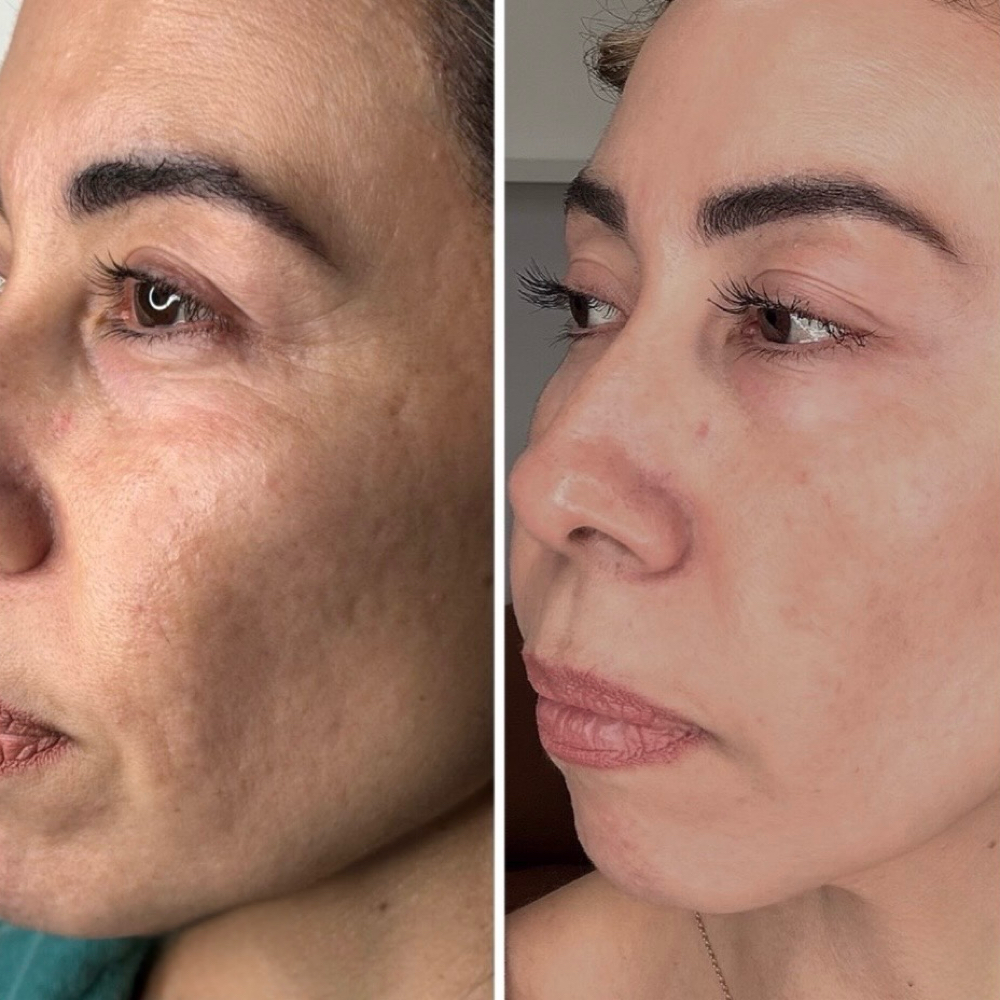 Ethereal T33 Ultra Cold Plasma at Ethereal Esthetics By Ashley in Flagstaff, AZ
