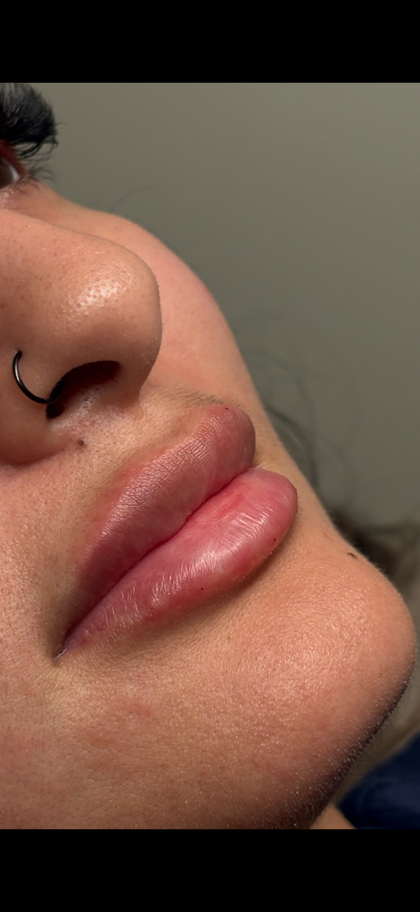 Versa Half Syringe at Aura Skin x Marissa in Alice, TX