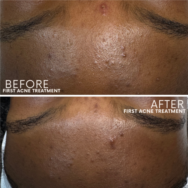 Skin Health Treatment at Glow Aesthetics Studio in Atlanta, GA