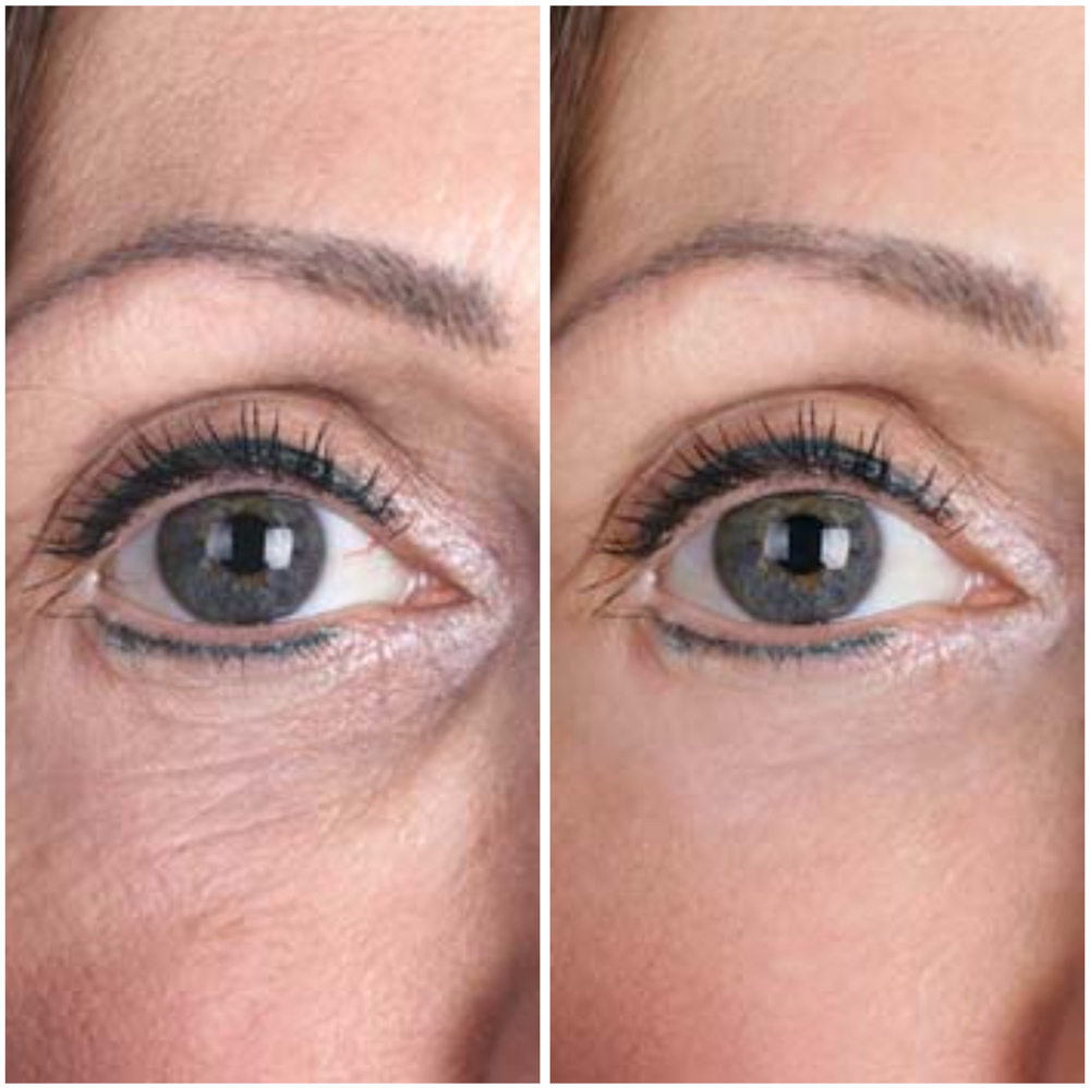 PRF (Platelet-Rich-Fibrin) at Allure Aesthetics & Wellness Studio in Midwest City, OK