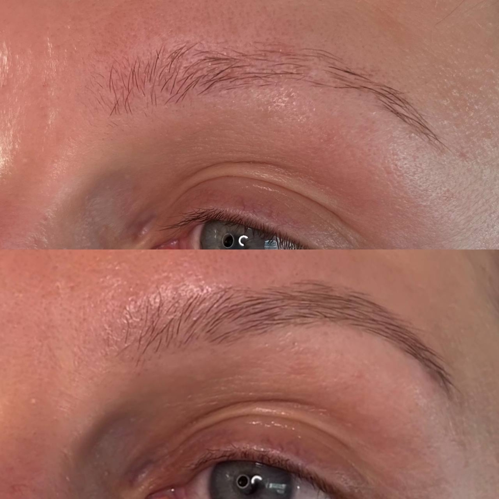 Brow Restoration Treatment
