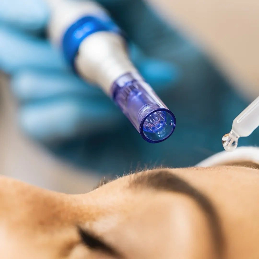 Microneedling with Hyaluronic Acid
