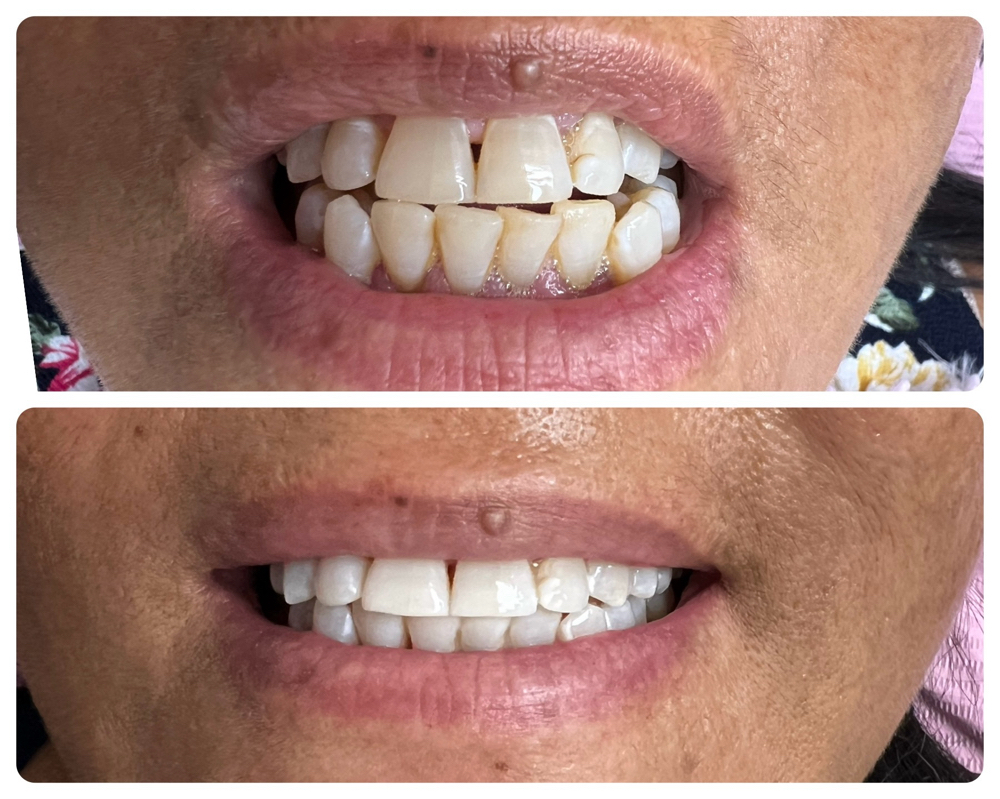 Teeth Whitening 1 Hour