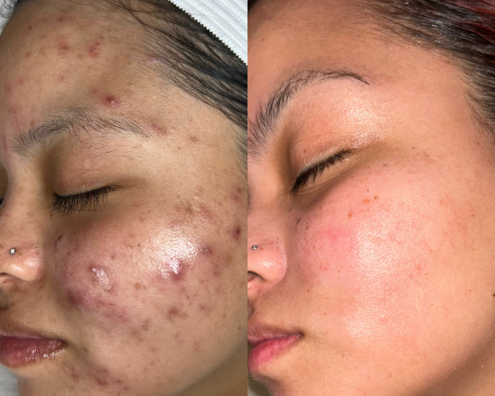 Medium Corrective Peel at Jisell Aesthetics in Houston, TX