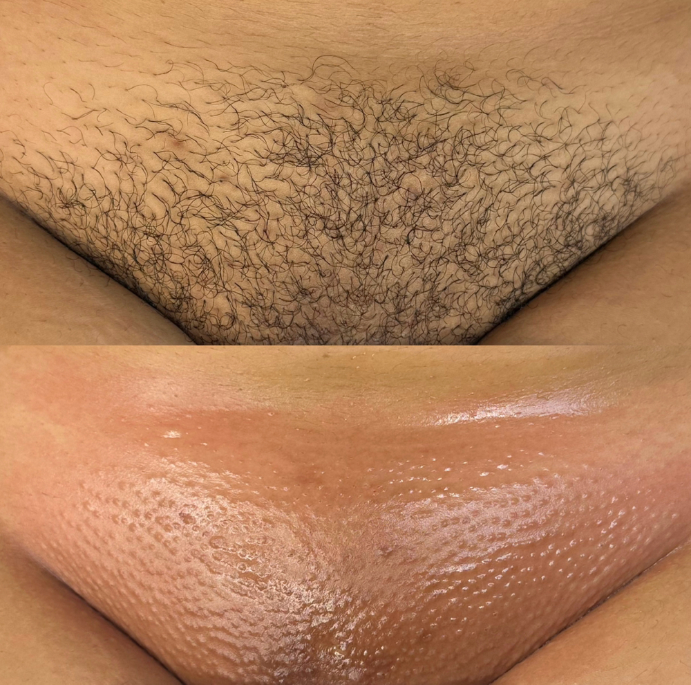 Brazilian Wax