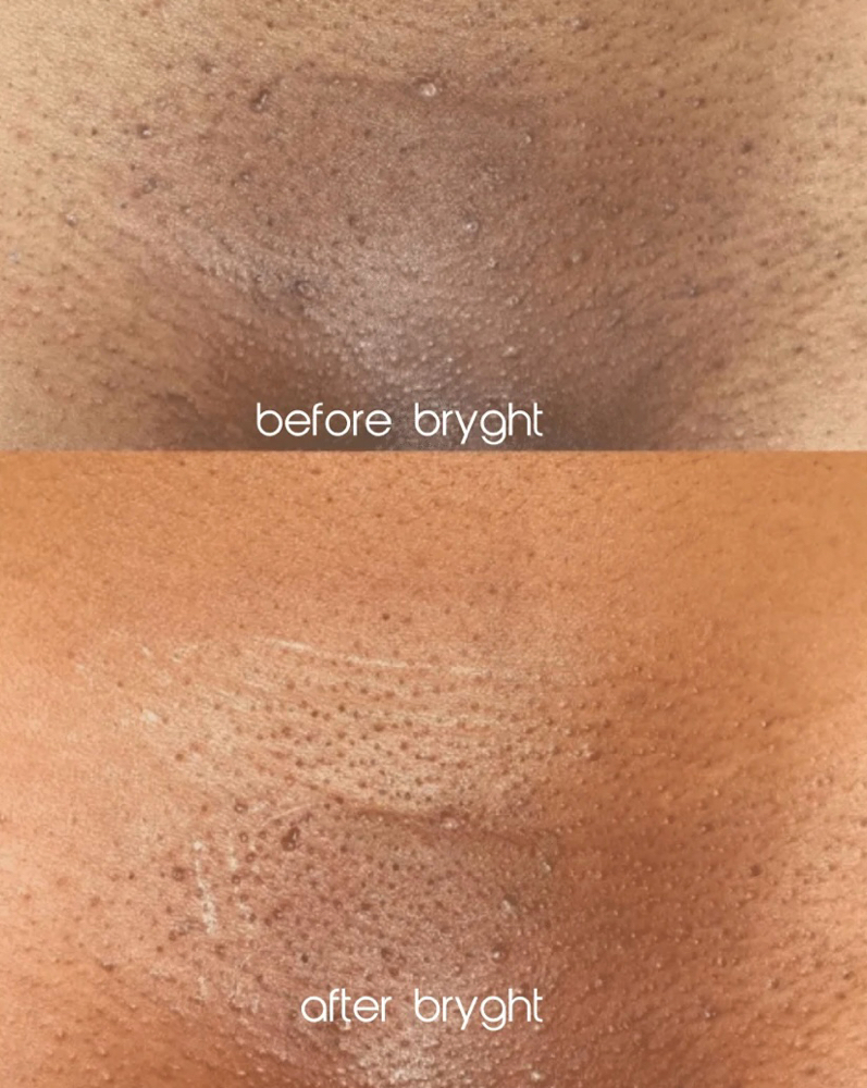 Intimate Bleaching-Bikini Region
