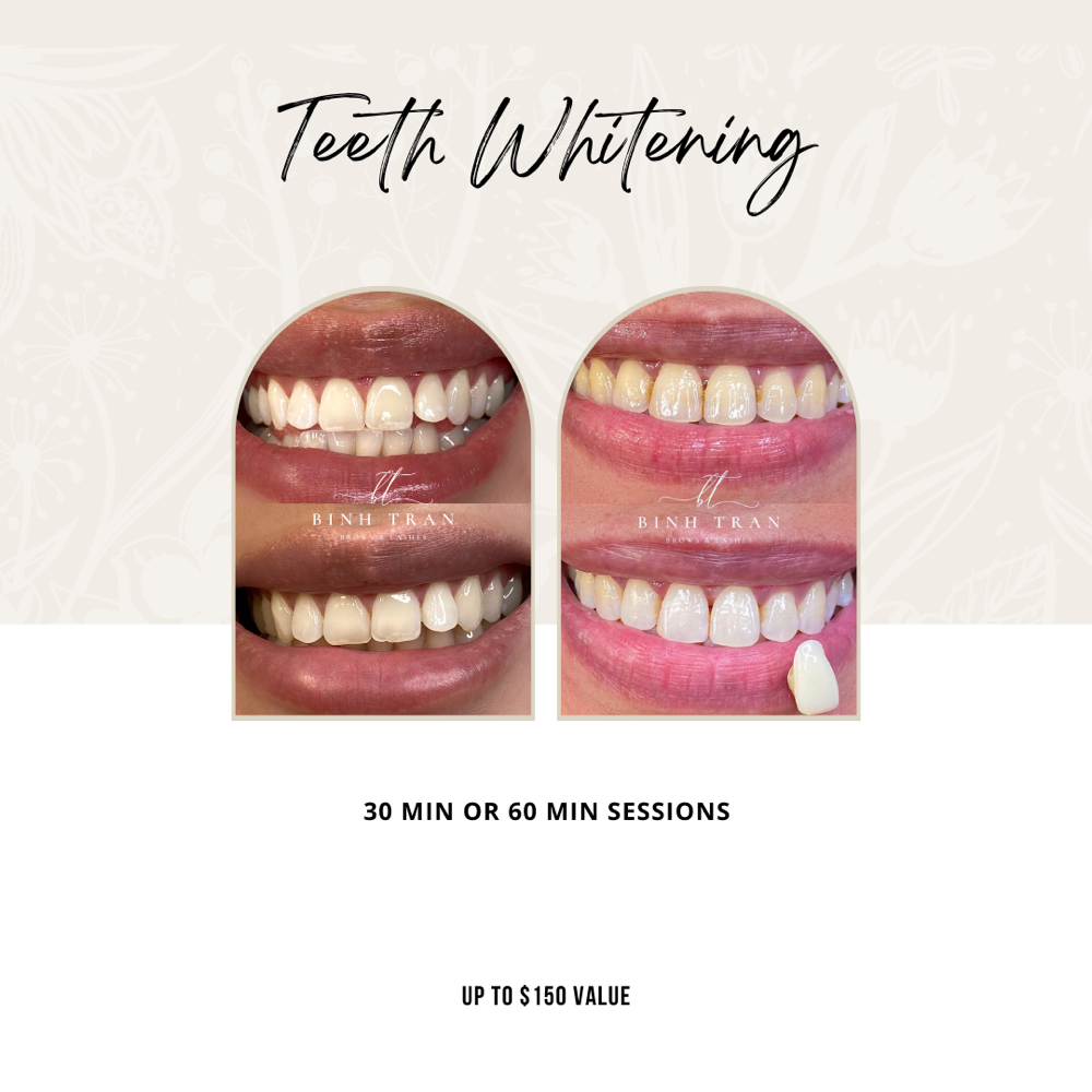 Maintenance Teeth Whitening Touchup