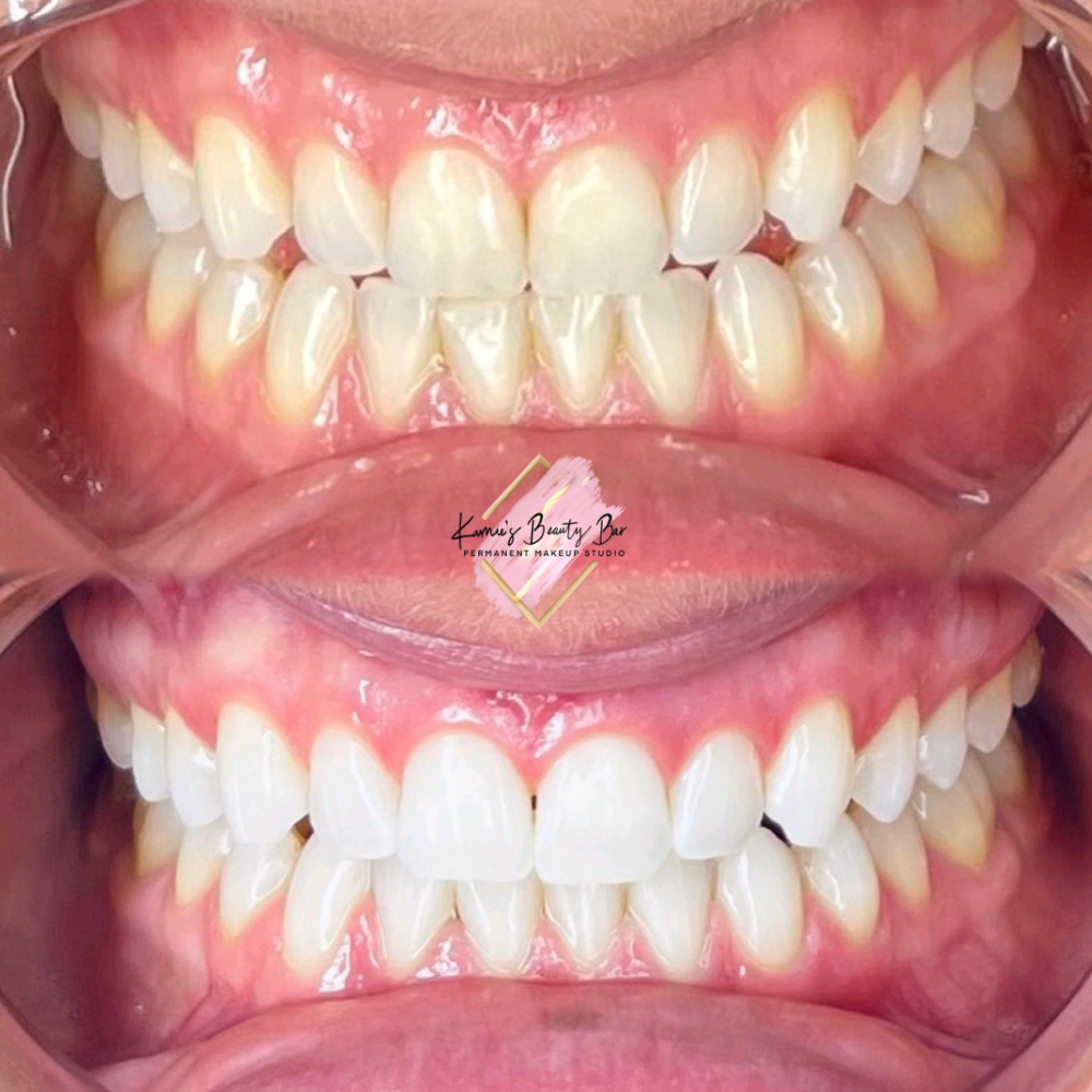 Teeth Whitening (Dental Grade)