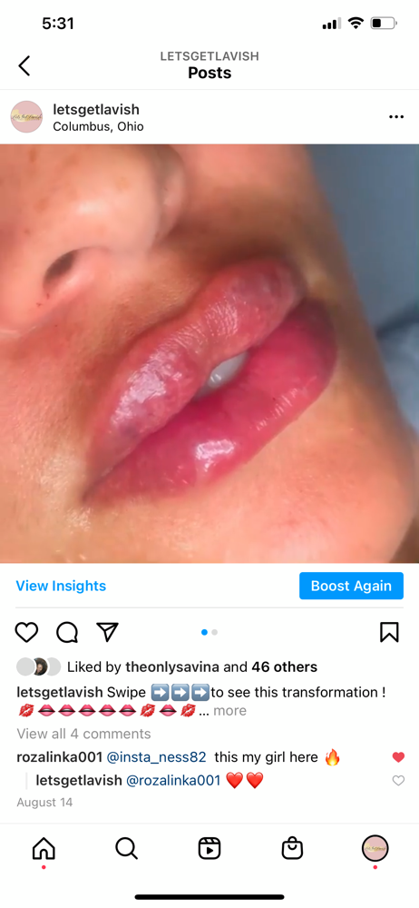 Lip Fillers Touch Up - No needle