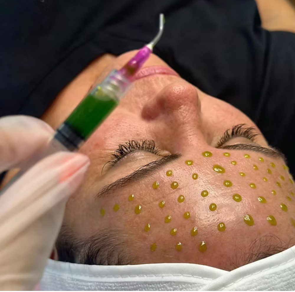 ADD ON BioRePeel to MicroNeedling