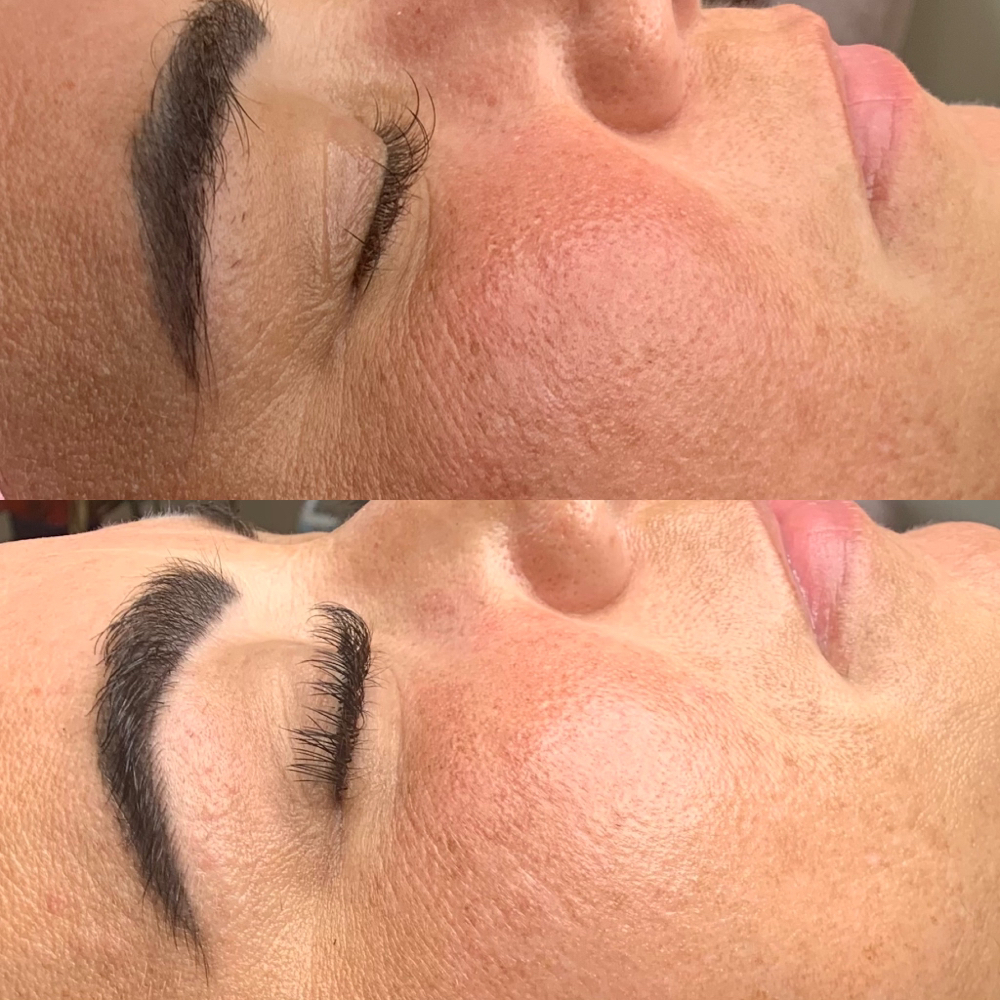 Deep Pore + Dermaplane