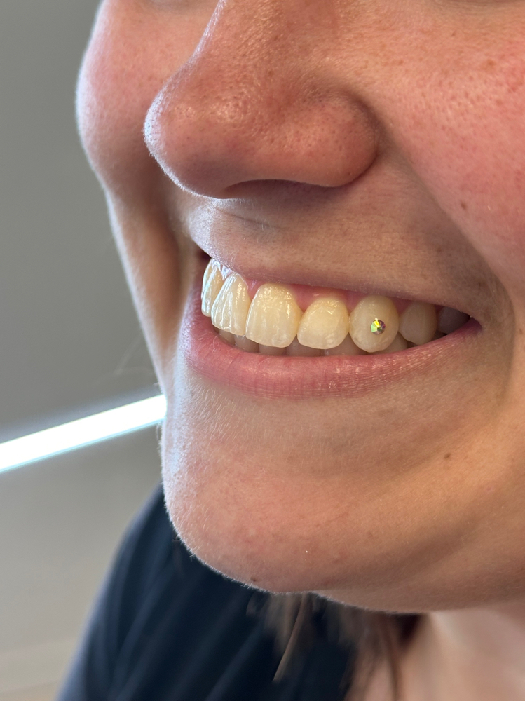 Tooth Gems