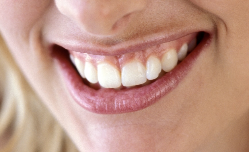 Gummy Smile