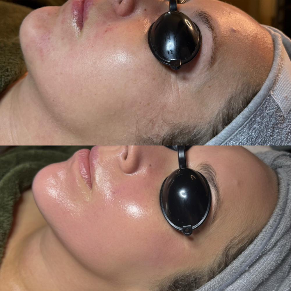 Needle-Free Filler Facial at The Fine Line in Buffalo, NY