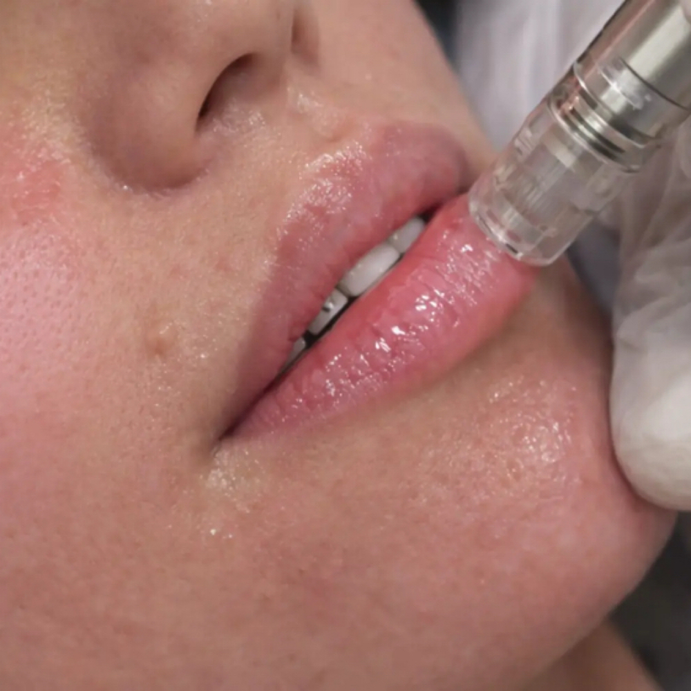 Lip Microneedling at Flawless Skin By Sarah in Roseville, CA