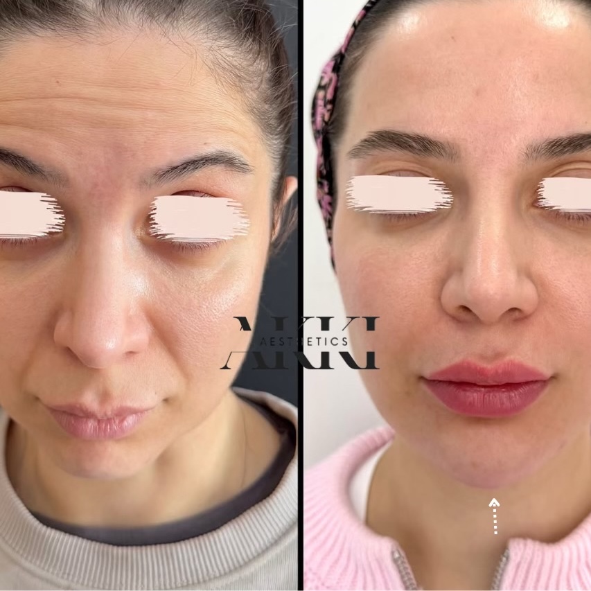 Chin Filler (ML) at Akki Aesthetics in Williston Park, NY