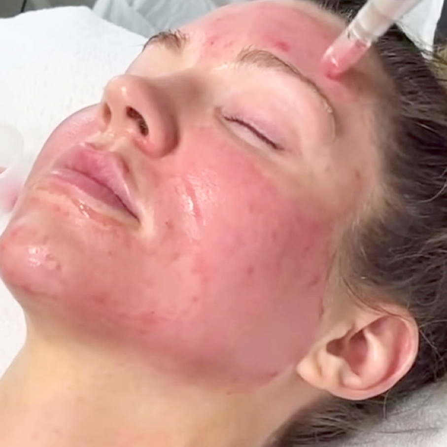 Microneedling Infused HA