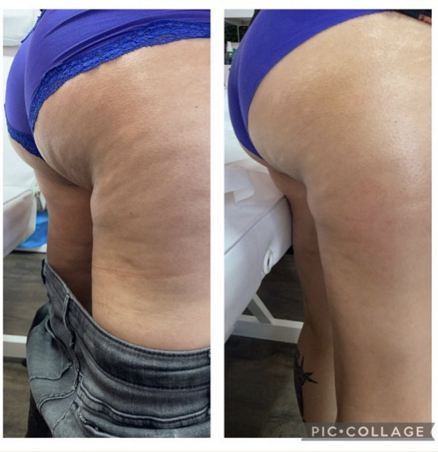 Cellulite Reduction