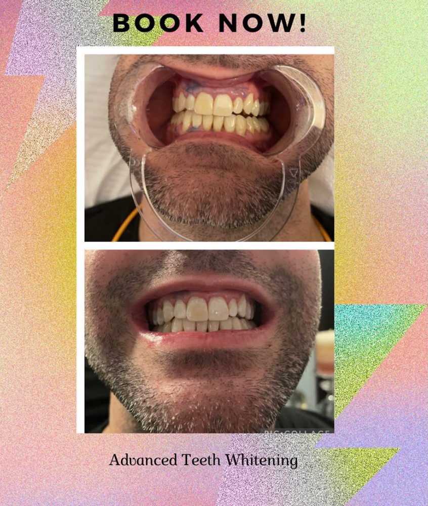 Teeth Whitening Bundle Deal