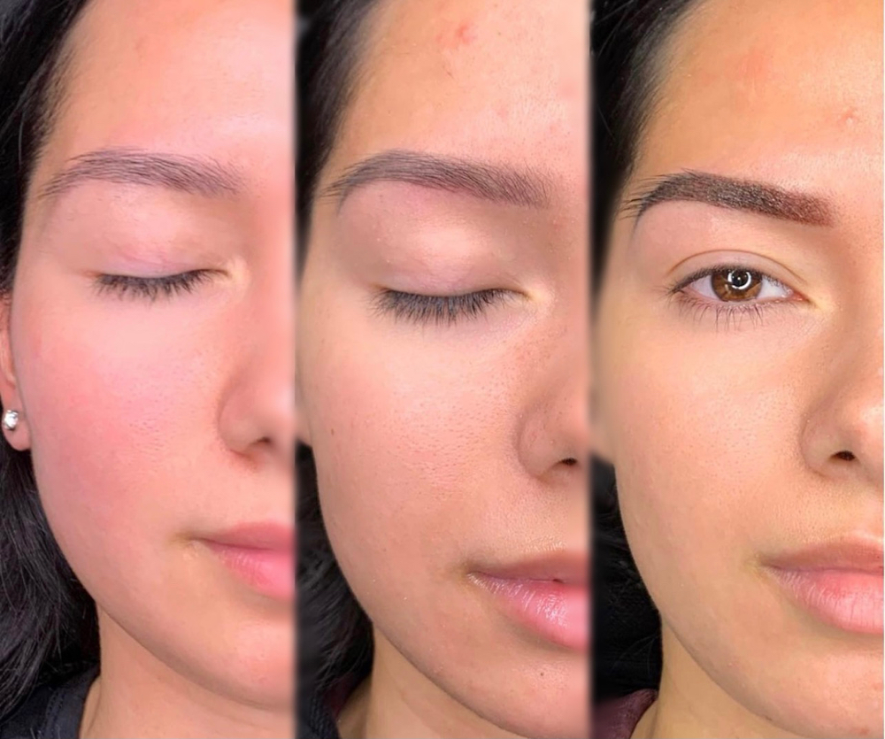 Brow Tattoo Removal