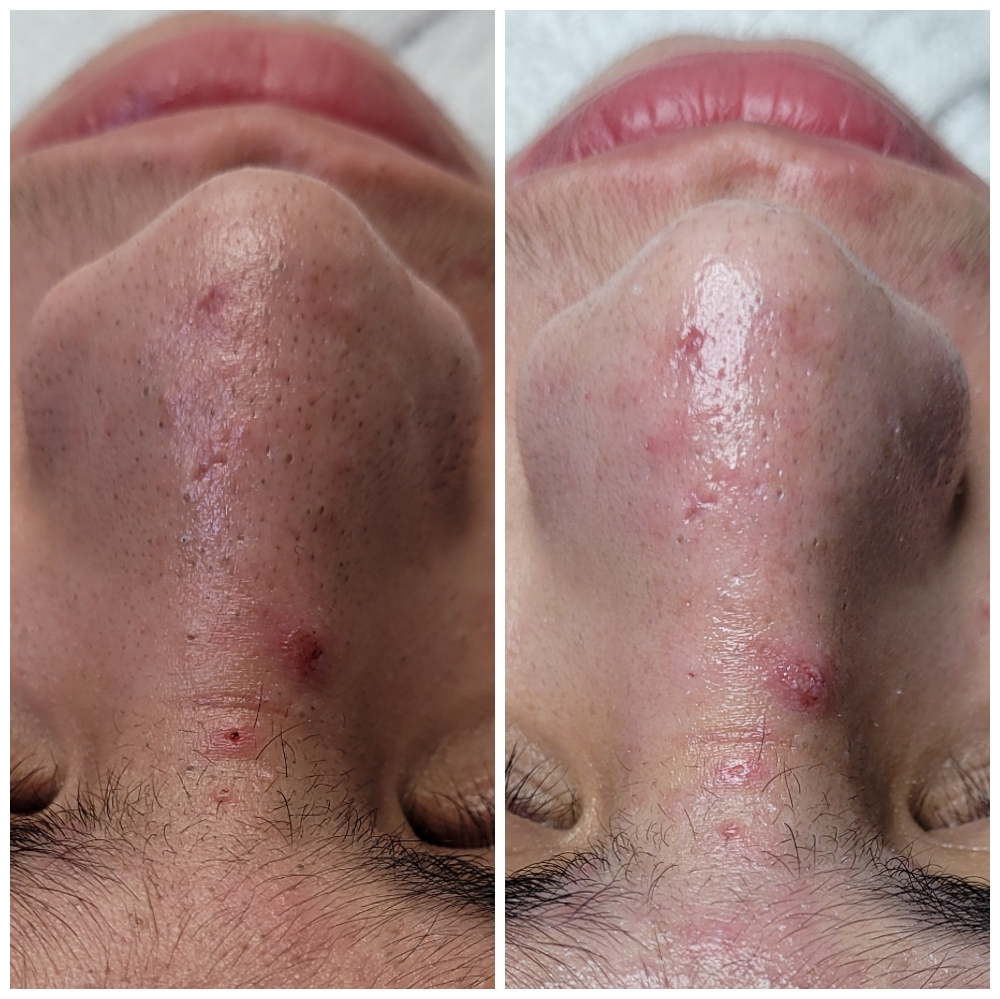 Acne/Deep Clean Facial