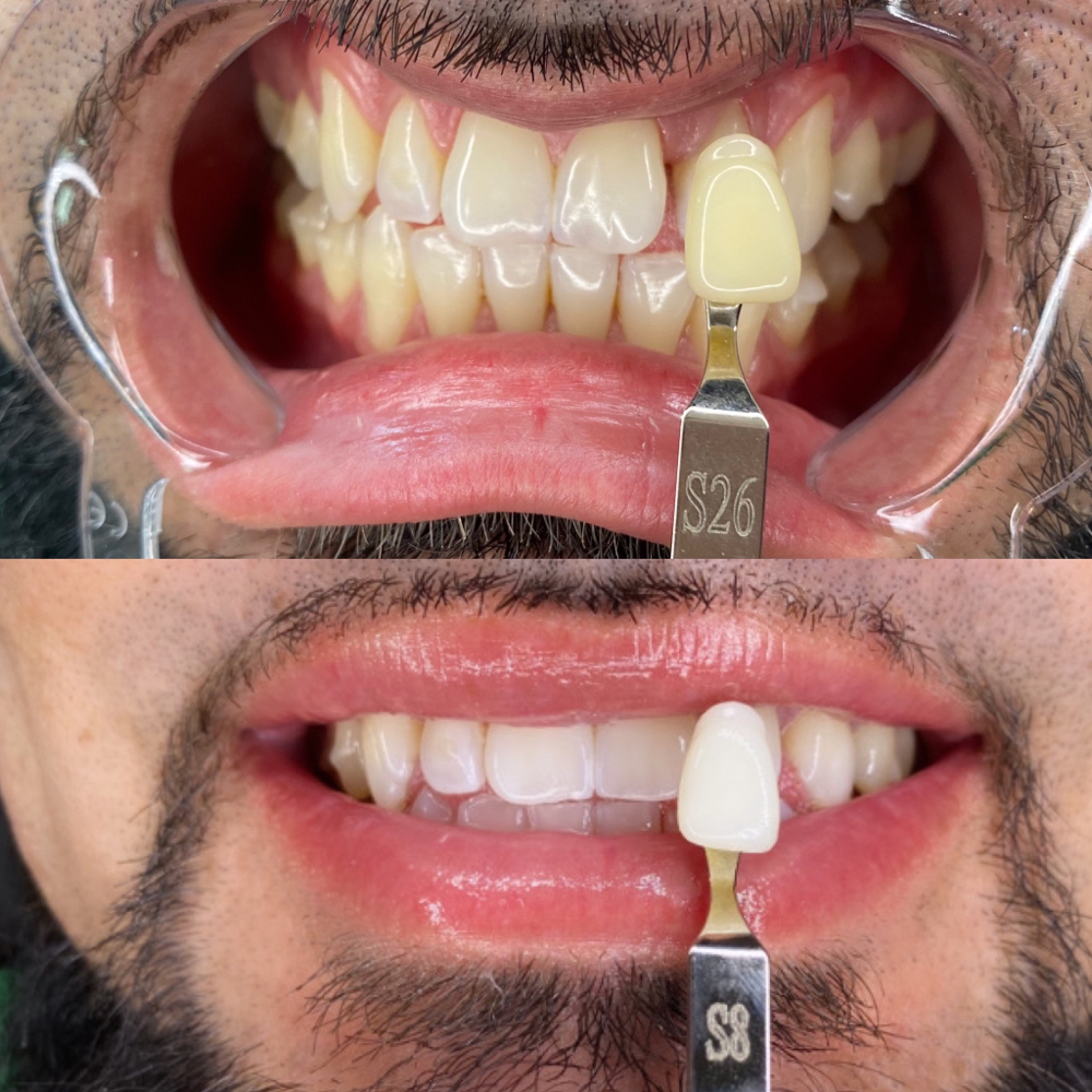 Teeth Whitening