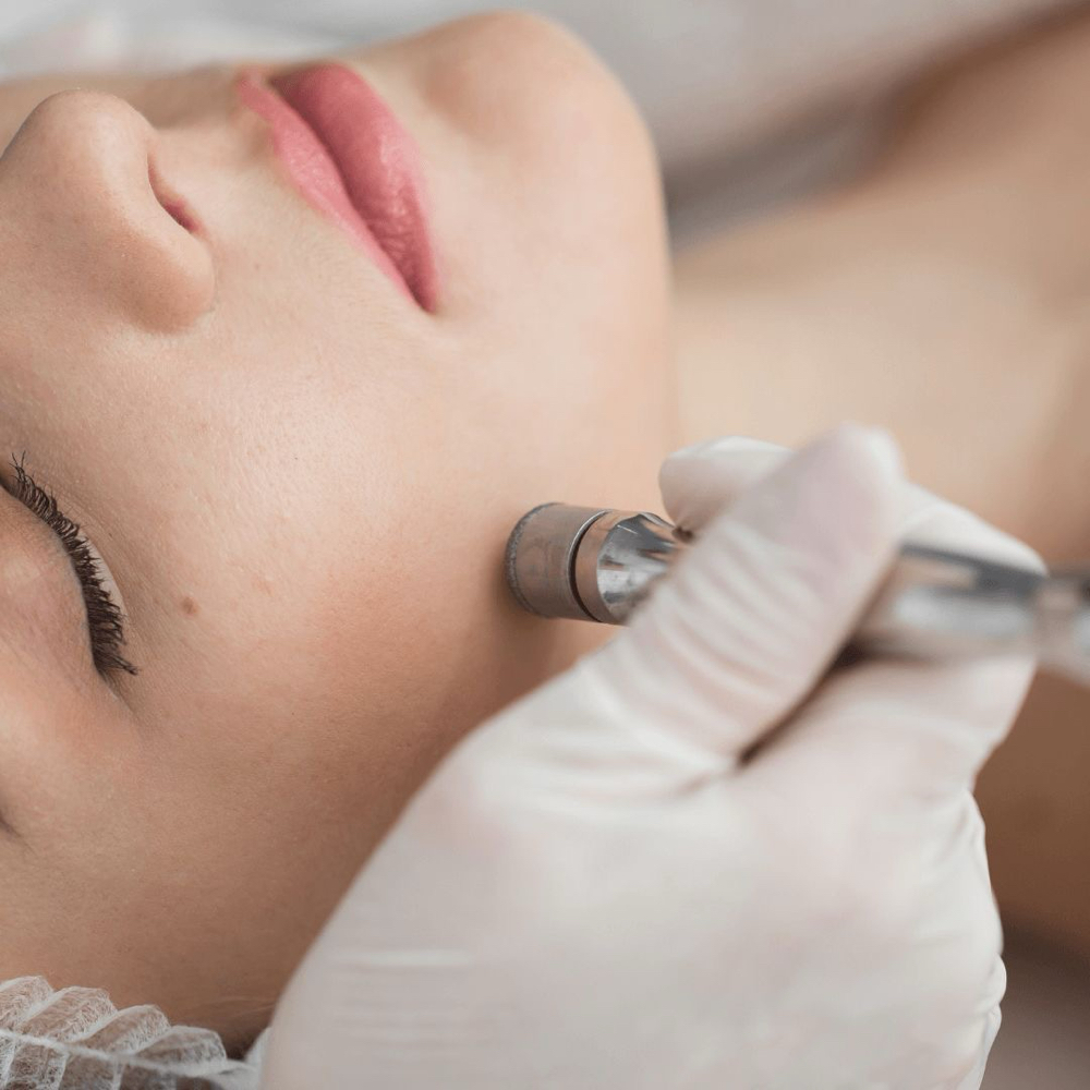 Microdermabrasion Facial