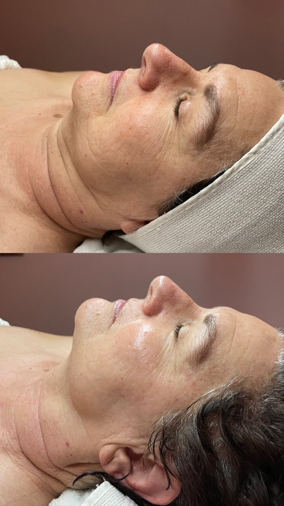 Alkaline Wash - Scar Revision DMK