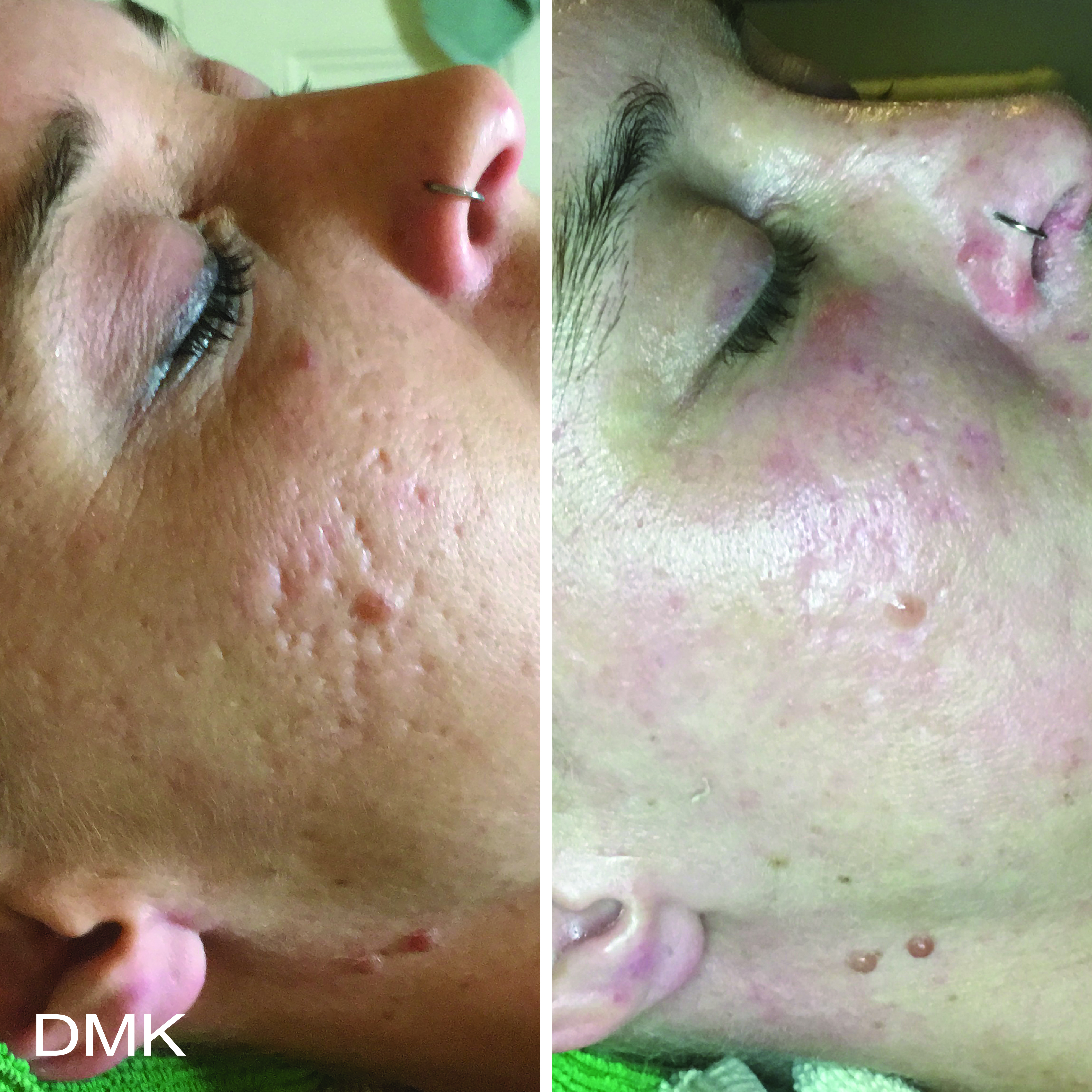 Alkaline Wash - Scar Revision DMK