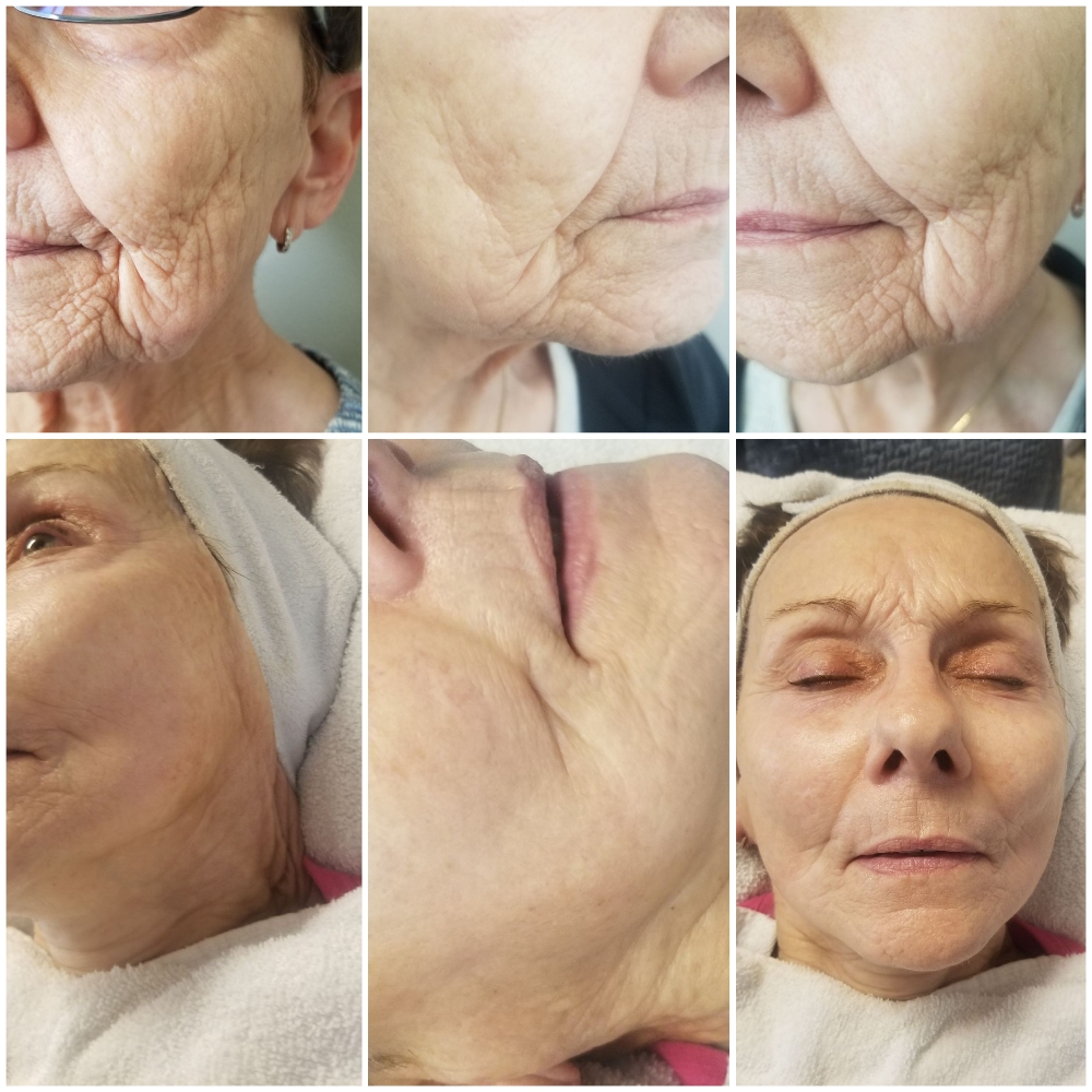 Fibroblast Skin Tightening