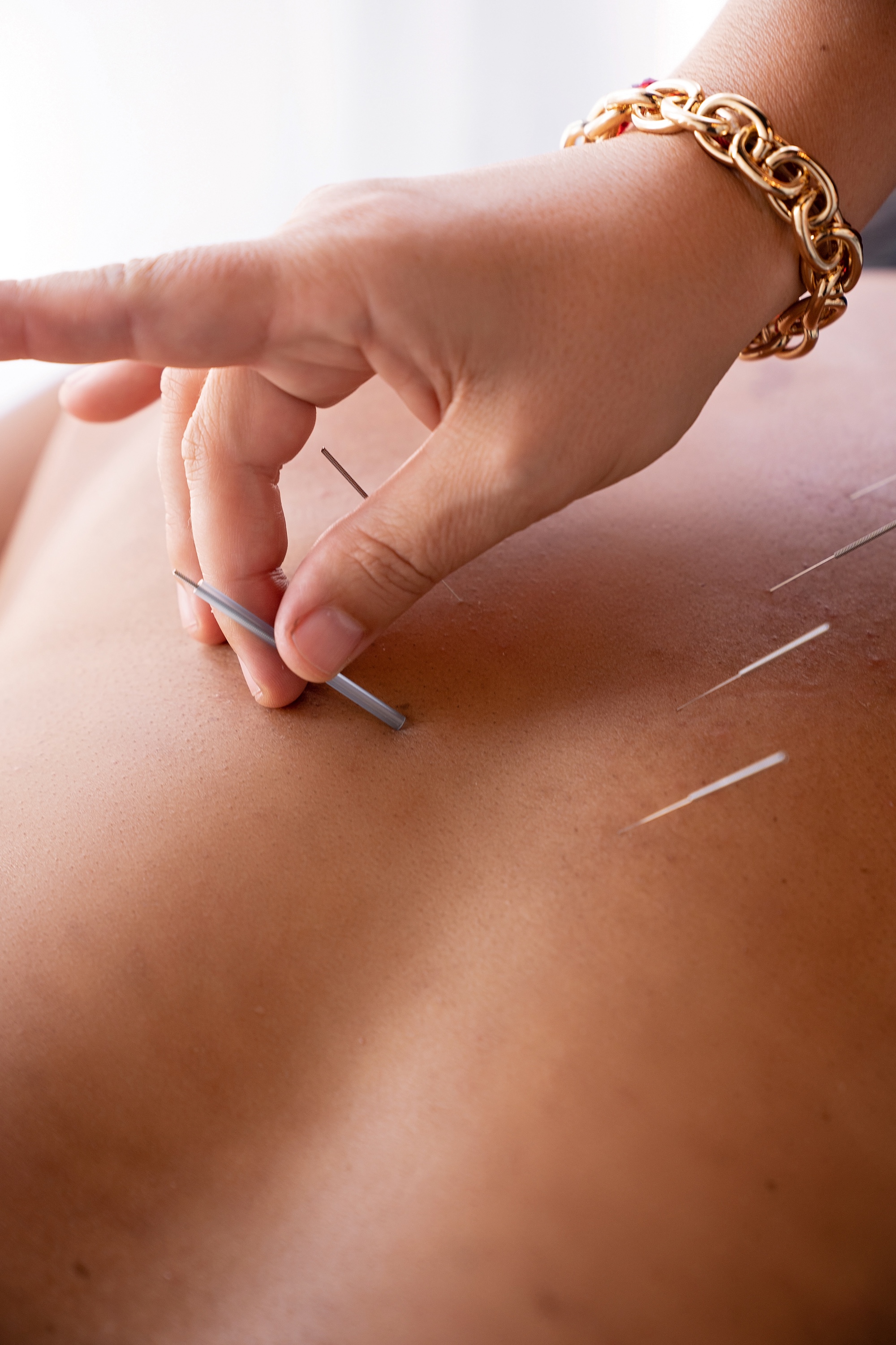 New Patient Private Acupuncture