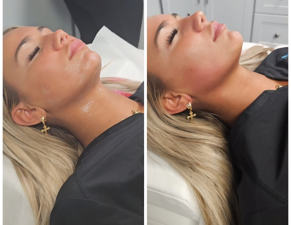 Jawline Sculpting Cryo