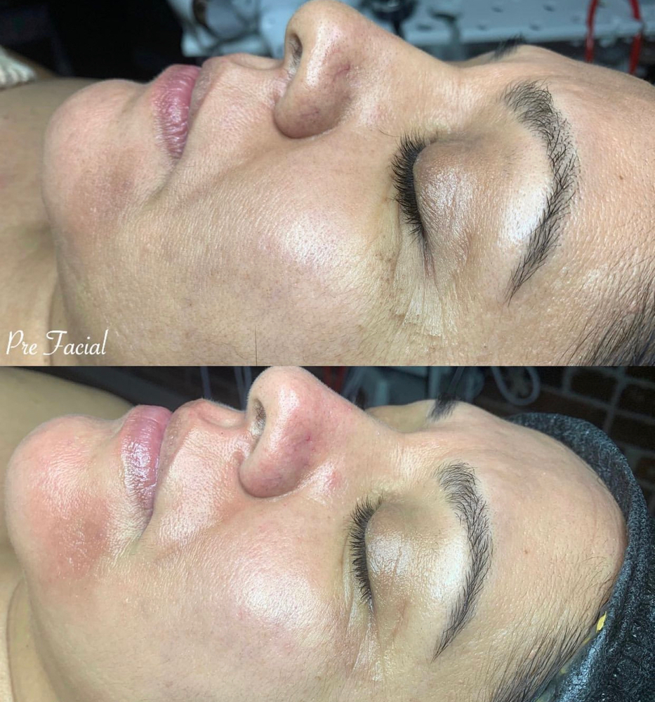 Microdermabrasion Facial