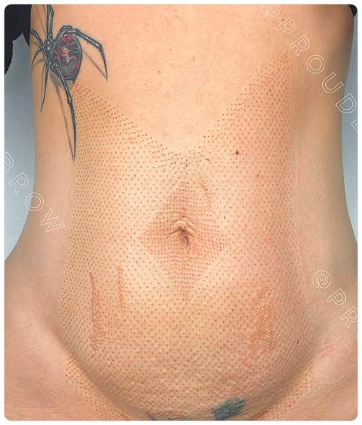 Corset (Entire Abdominal Area)