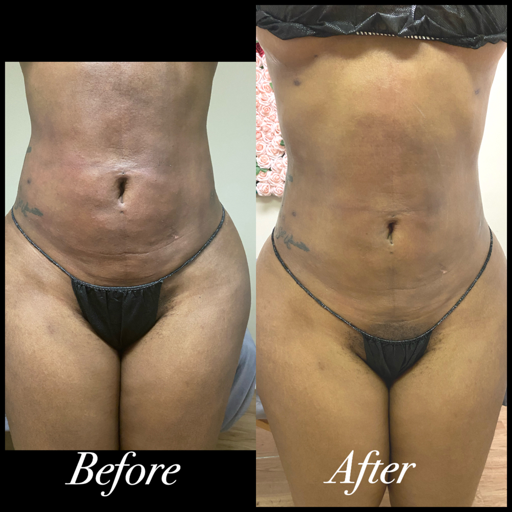Post-op Masage