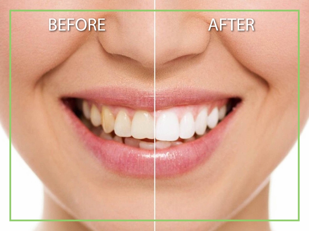 Professional Teeth Whitening