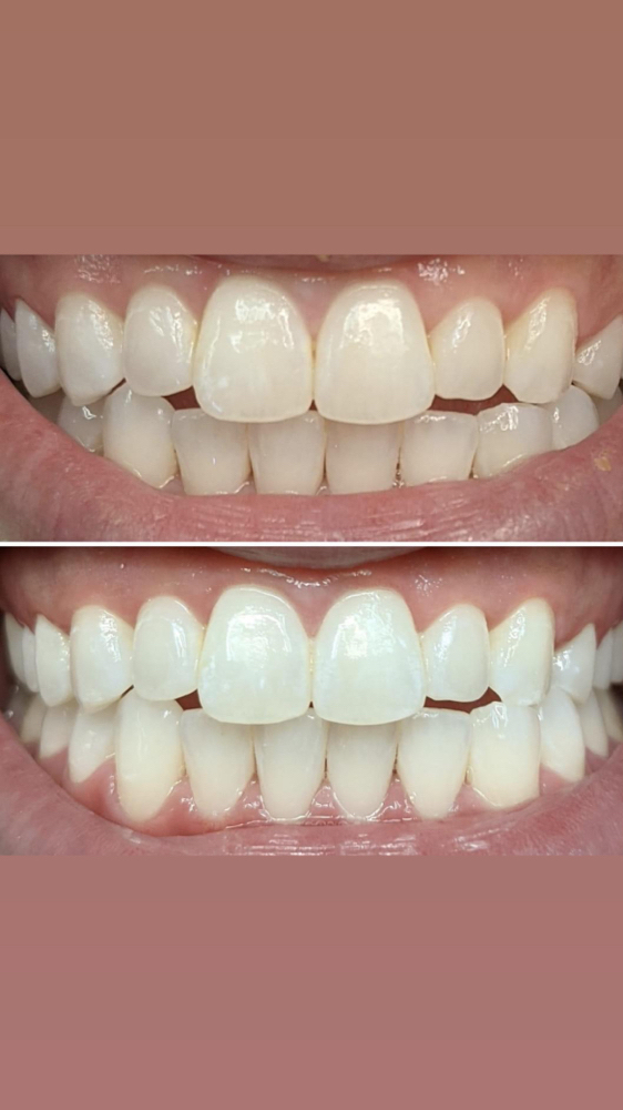 Professional Teeth Whitening