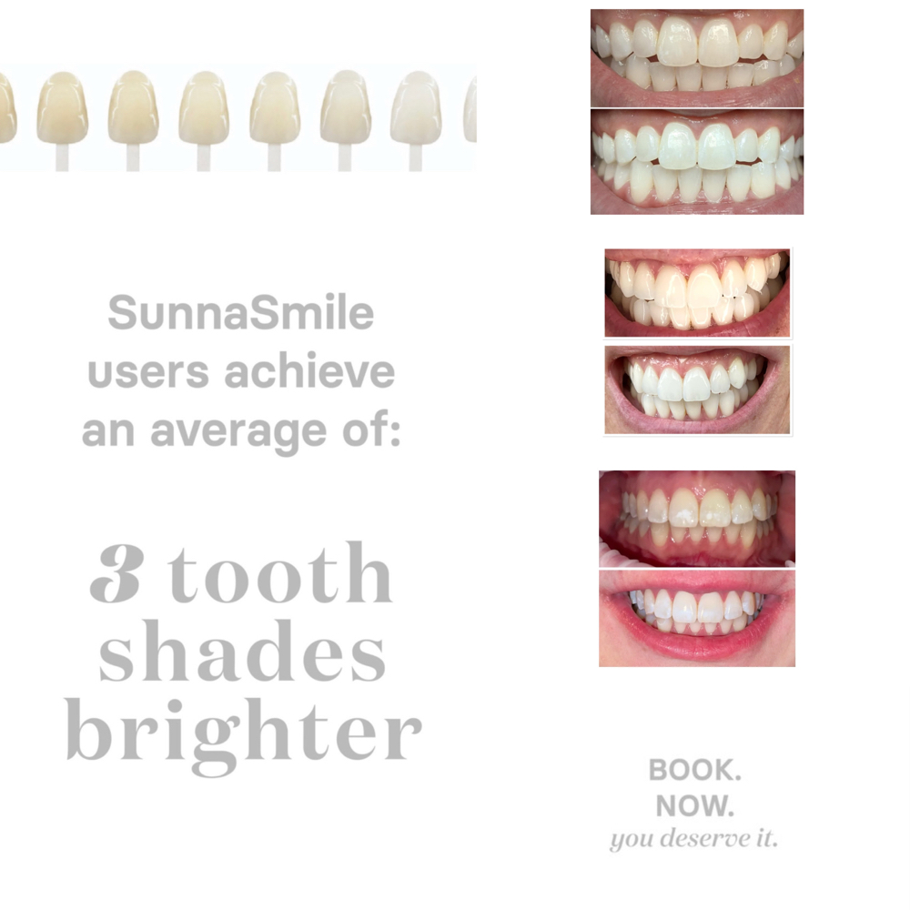 Professional Teeth Whitening
