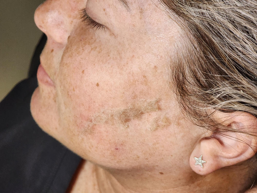 Dermaplane Treatment Upgrade