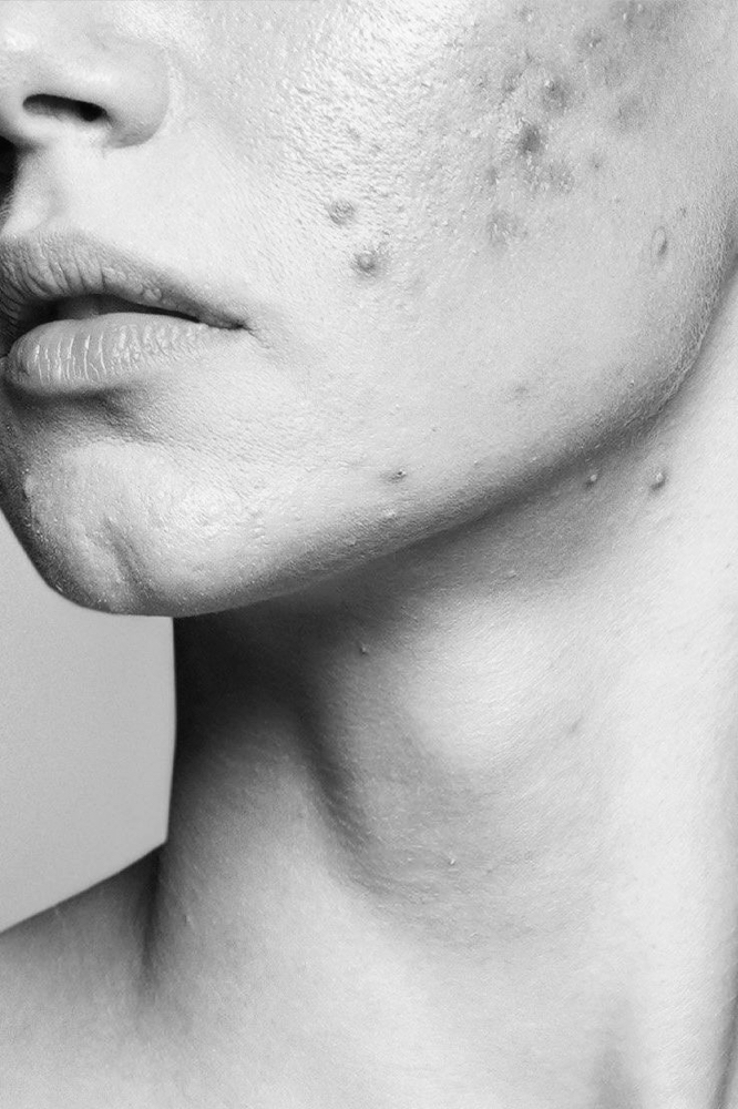 Acne Facial