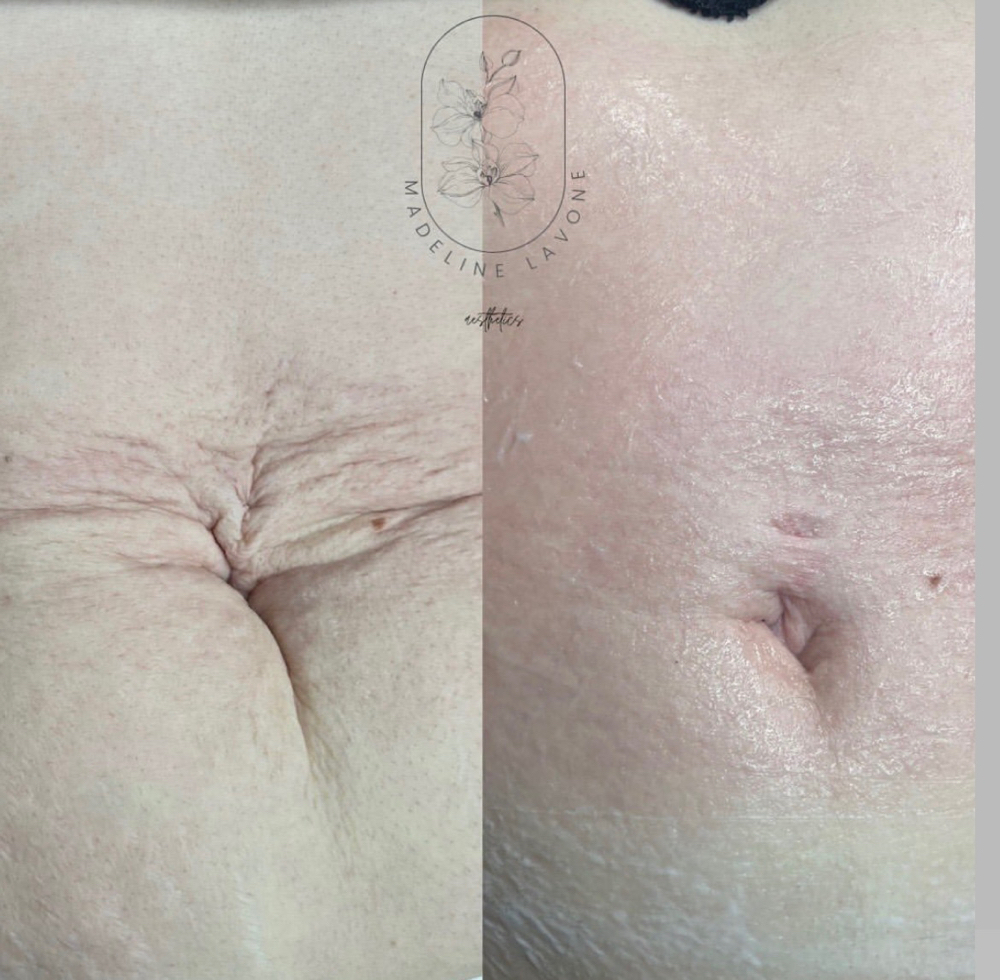 Stomach Microneedling
